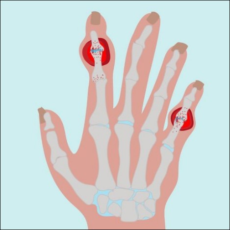 rheumatoid arthritis_square